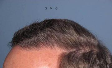 Photo showing closeup of hairline 10 months postoperative