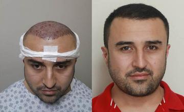 Front view - Before and after hair transplant surgery result pictures