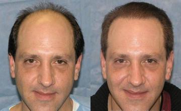 Before and after frontal view of 
