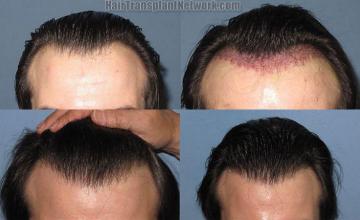 Hair transplant photos viewed from the front