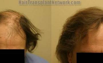 Before and after hair restoration photos