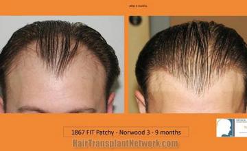 Before and after hair transplant procedure images