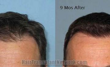 Hair restoration procedure before and after results