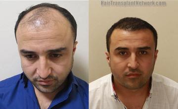 Front view - Before and after hair transplant surgery result images