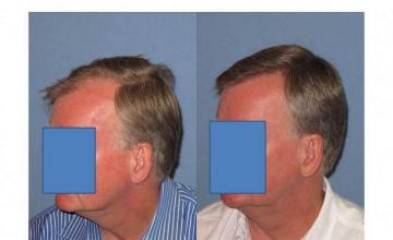 Left side hair transplant results