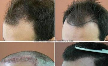 Hair transplantation surgery before and after photos