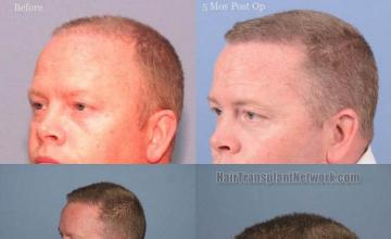 Hair transplantation surgery before and after pictures