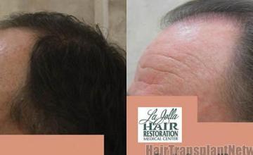 Hair transplantation surgery before and after images