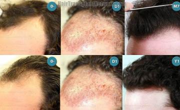 Hair transplantation surgery before and after pictures