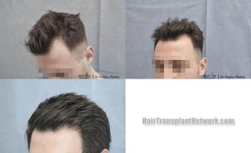 Hair restoration procedure before and after pictures