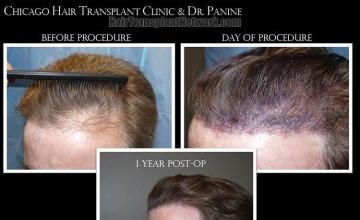 Hair transplantation surgery before and after pictures