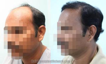 Hair transplantation surgery before and after photos