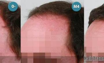 Hair transplantation surgery before and after pictures