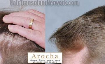 Hair transplantation surgery before and after images