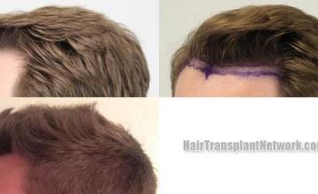 Hair transplantation surgery before and after photos