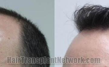 Hair transplantation surgery before and after pictures