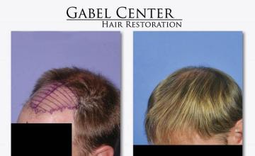 Hair transplant surgery before and after photos