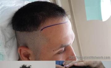 Hair restoration surgery before and after photographs