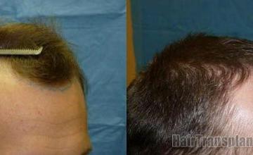 Hair restoration procedure - right side photos