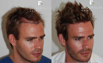 Hair transplantation surgery before and after photos