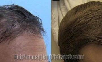 Hair transplantation surgery before and after images