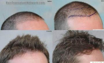 Hair transplantation surgery before and after photos