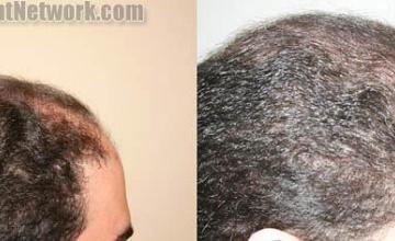 Hair transplantation surgery before and after photos