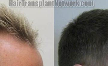 Hair transplantation surgery before and after pictures