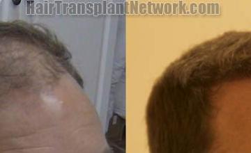 Hair transplantation surgery before and after images