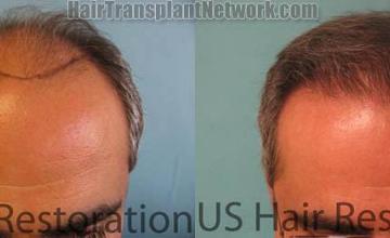 Hair restoration procedure before and after pictures