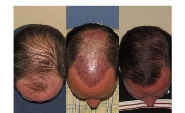 Hair restoration results - Top view- Two sessions