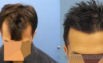 Top view of hair restoration outcome