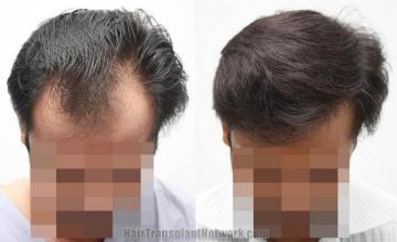 Hair restoration procedure before and after results