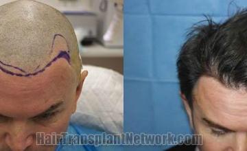 Hair transplantation surgery before and after photos