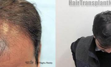 Hair transplantation surgery before and after photos