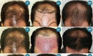 Hair transplantation surgery before and after photos