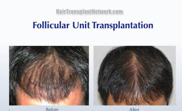 Hair transplantation surgery before and after pictures