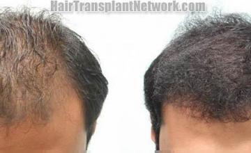 Hair restoration procedure before and after results