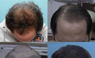 Top view - Before and after surgical hair replacement