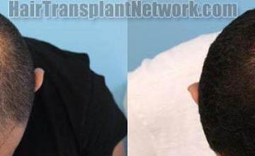 Top view - Before and after surgical hair replacement