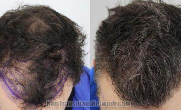 Top view before and after hair restoration results