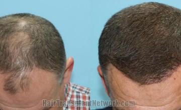 Hair restoration procedure before and after results