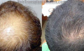 Hair restoration pictures left side views before and after