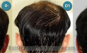 Hair restoration procedure before and after pictures