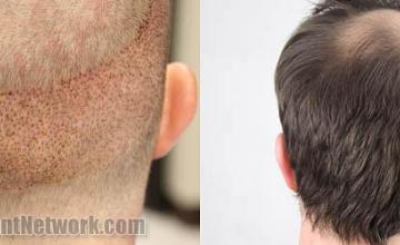 Hair restoration procedure before and after pictures