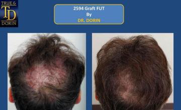 Hair transplant surgery before and after pictures