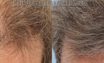 Hair restoration procedure before and after pictures