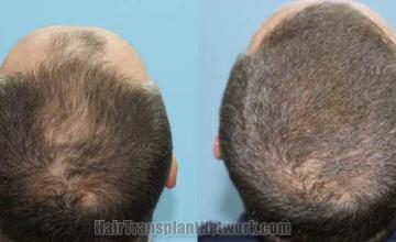 Hair transplantation surgery before and after pictures
