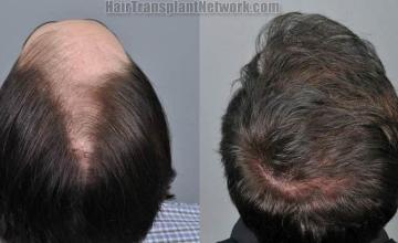 Hair replacement surgery before and after images