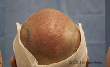 Hair restoration surgery before and after images